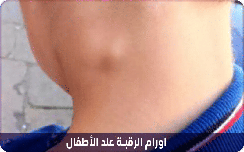 اورام الرقبة عند الأطفال