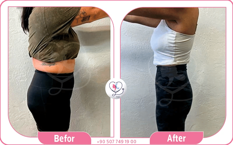 كيف يمكن تقليل الأعراض الجانبية لإبر المنجارو؟