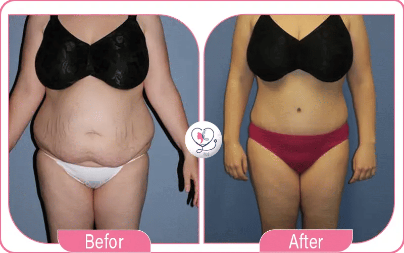 Approximate 360 Liposuction Prices by Country and City (2026 Updates)