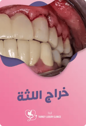 خراج اللثة: الأعراض المبكرة وكيفية العلاج الصحيح لتخفيف الألمfeatured image