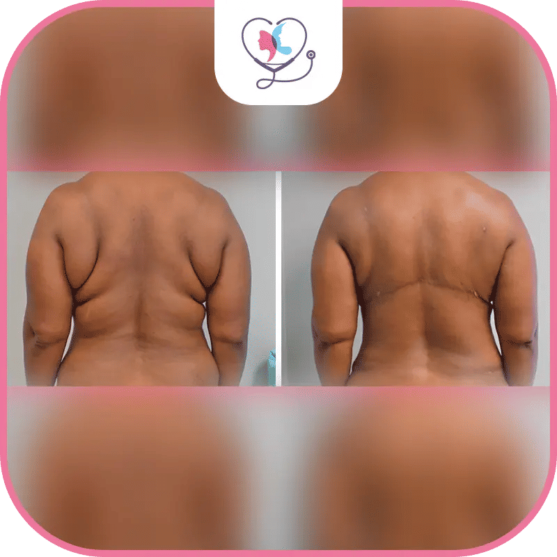 تجربتي مع عملية شد الظهر في تركيا