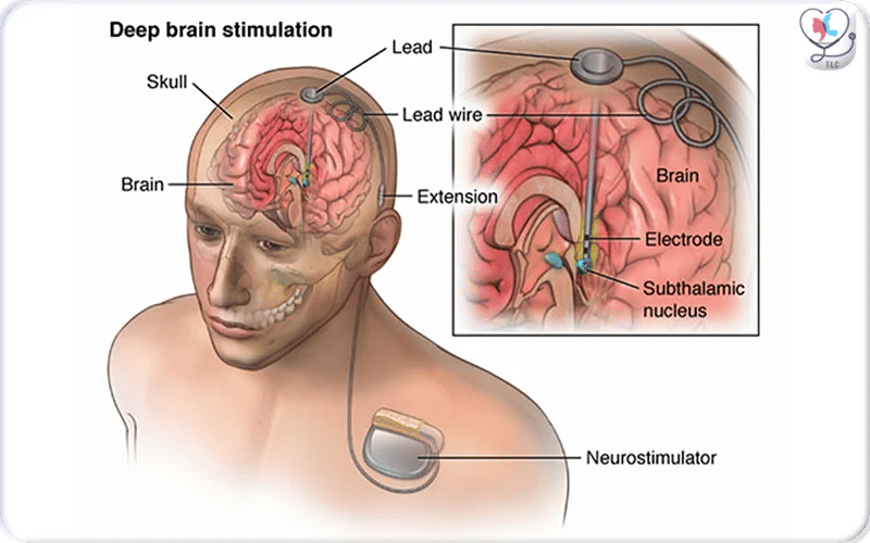 What is Deep Brain Stimulation Surgery? 3