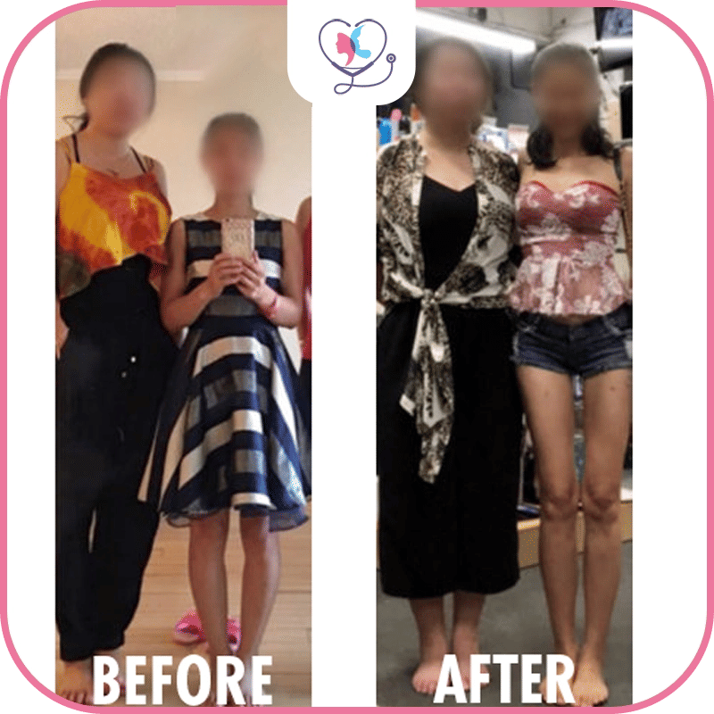 نتائج عملية تطويل القامة باستخدام تقنيّة سترايد