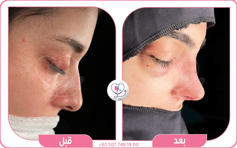 مزايا إجراء تجميل الأنف في تركيا لاكشري كلينك