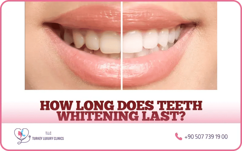 Teeth whitening results longevity in Turkey – professional whitening lasts 6 months to 2 years depending on lifestyle habits