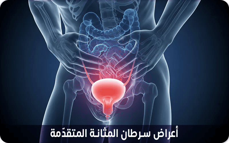 أعراض سرطان المثانة المتقدّمة