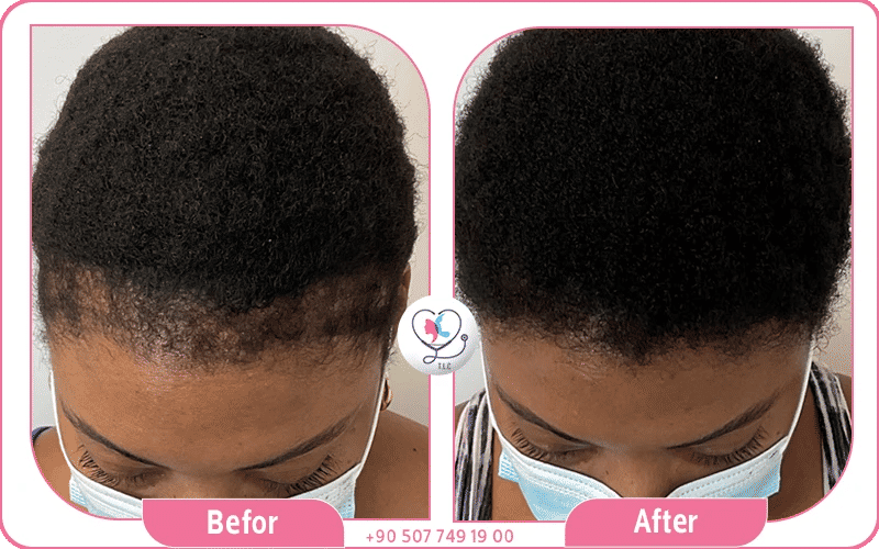 من هم المرشحون لزراعة الشعر الأفريقي؟