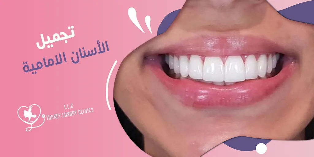 تجميل الأسنان الامامية:  أحدث الطرق والعلاجات في تركيا