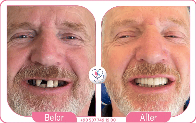 couronne implant dentaire avant après