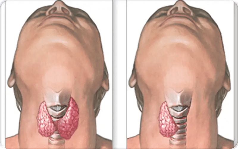 سعر عملية استئصال الغدة الدرقية بالليزر