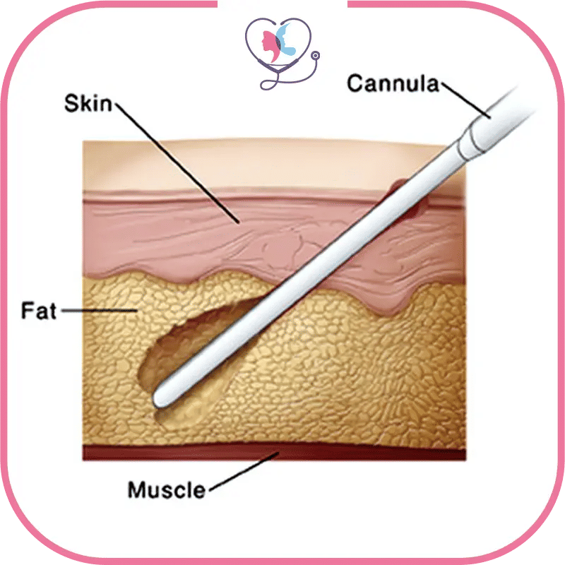 liposuccion technique