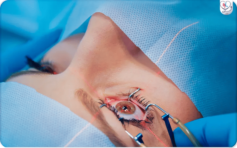 Suivi et post-opératoire après un LASIK