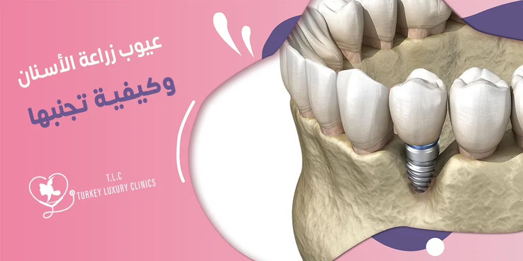 عيوب زراعة الأسنان وكيفية تجنبها دليل شامل 2026