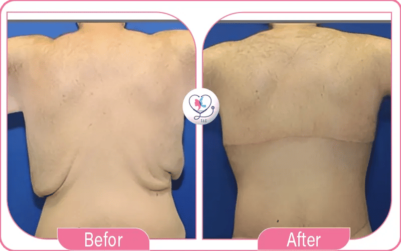 4. Upper Back: After Lipo 360