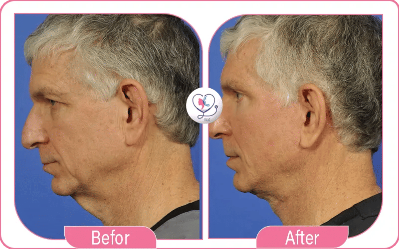 Before & After Results for Male Neck Lift