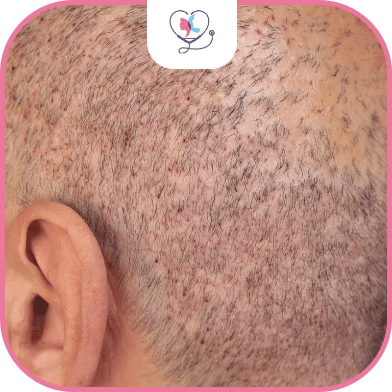 شفاء المنطقة المانحة بعد زراعة الشعر