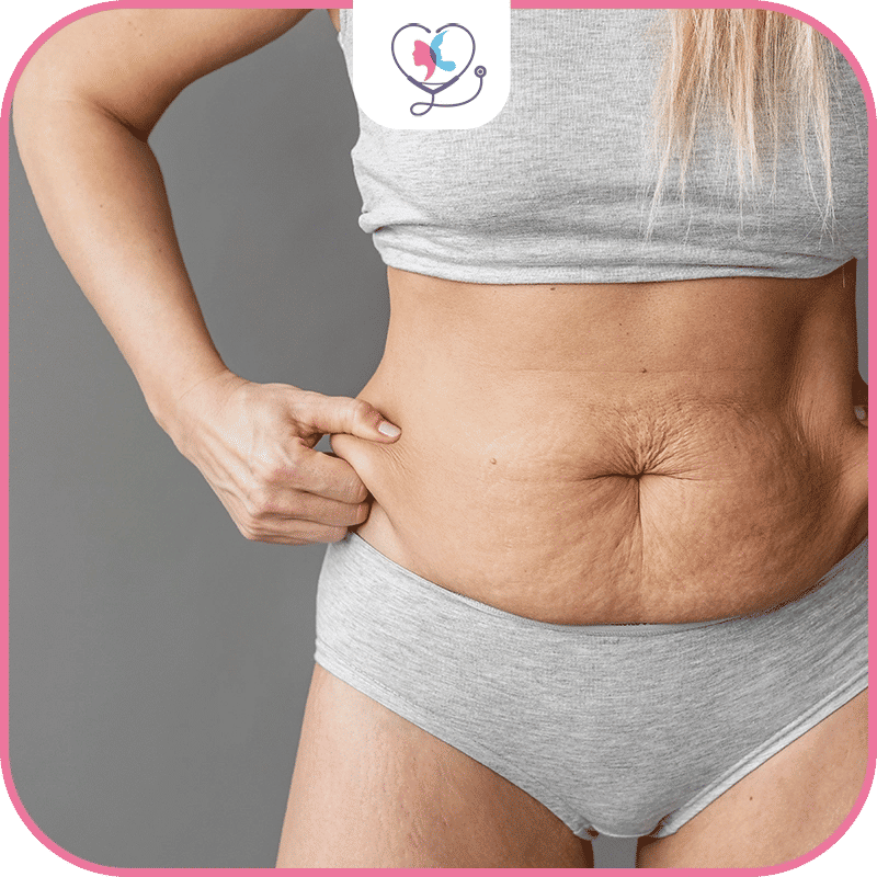 liposuccion echec -  liposuccion turquie - cicatrice liposuccion