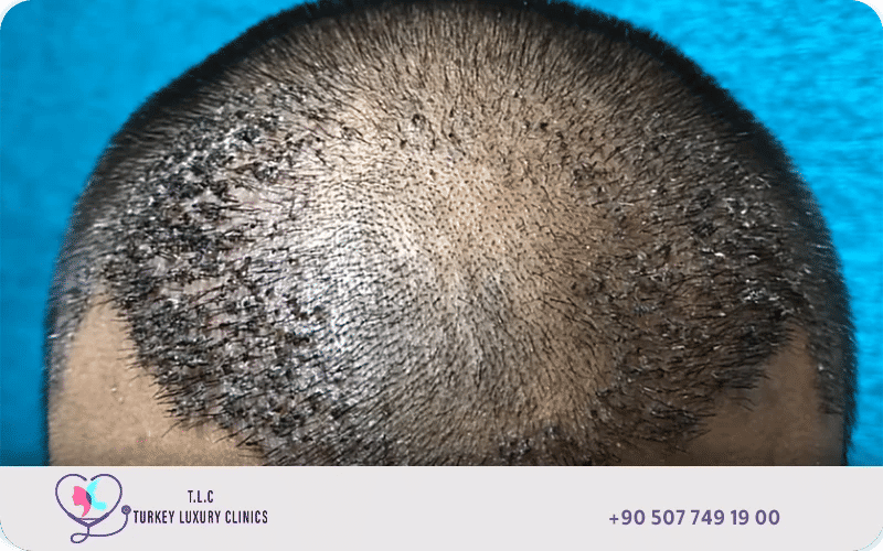 Hair transplant scabs forming on the scalp around transplanted follicles during the normal healing process after surgery