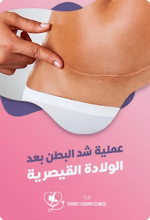 عملية شد البطن بعد الولادة القيصريةfeatured image