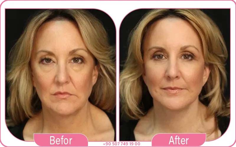 How to Choose the Best Deep Plane Facelift Surgeon in Turkey