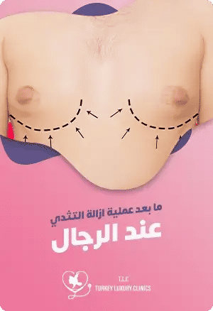 ما بعد عملية ازالة التثدي عند الرجالfeatured image