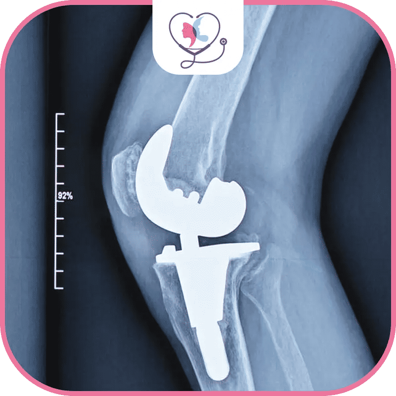 مخاطر عملية تغيير مفصل الركبة