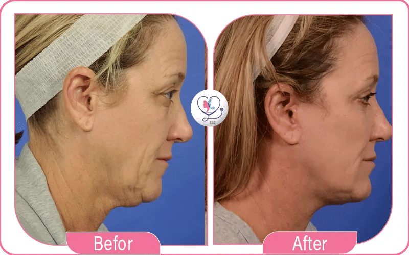 Turkey Neck Lift Before & After Results