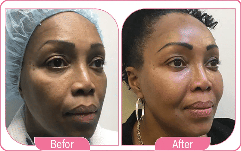 Qu'est-ce que le lipofilling visage ?