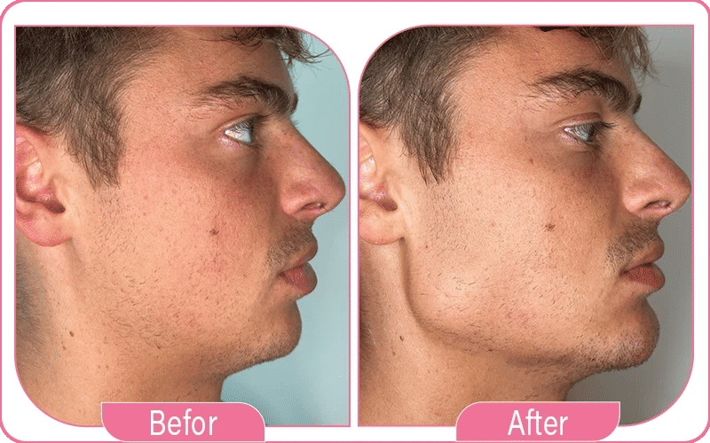 ما بعد تحديد الفك والذقن بدون جراحة