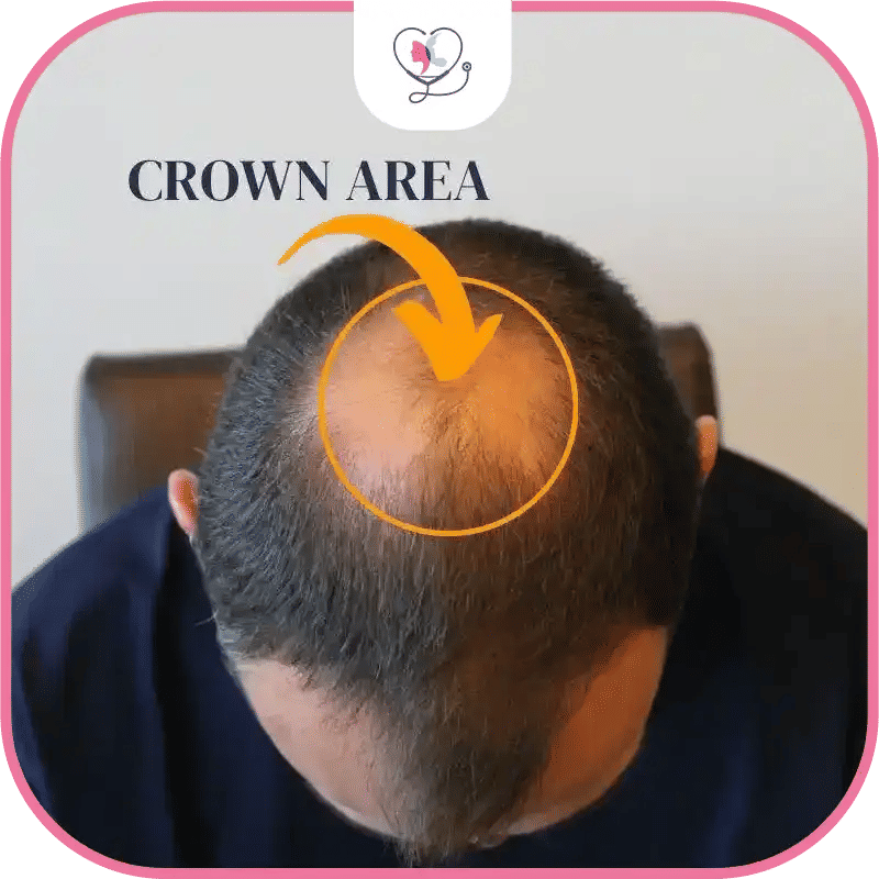 What is Crown Balding