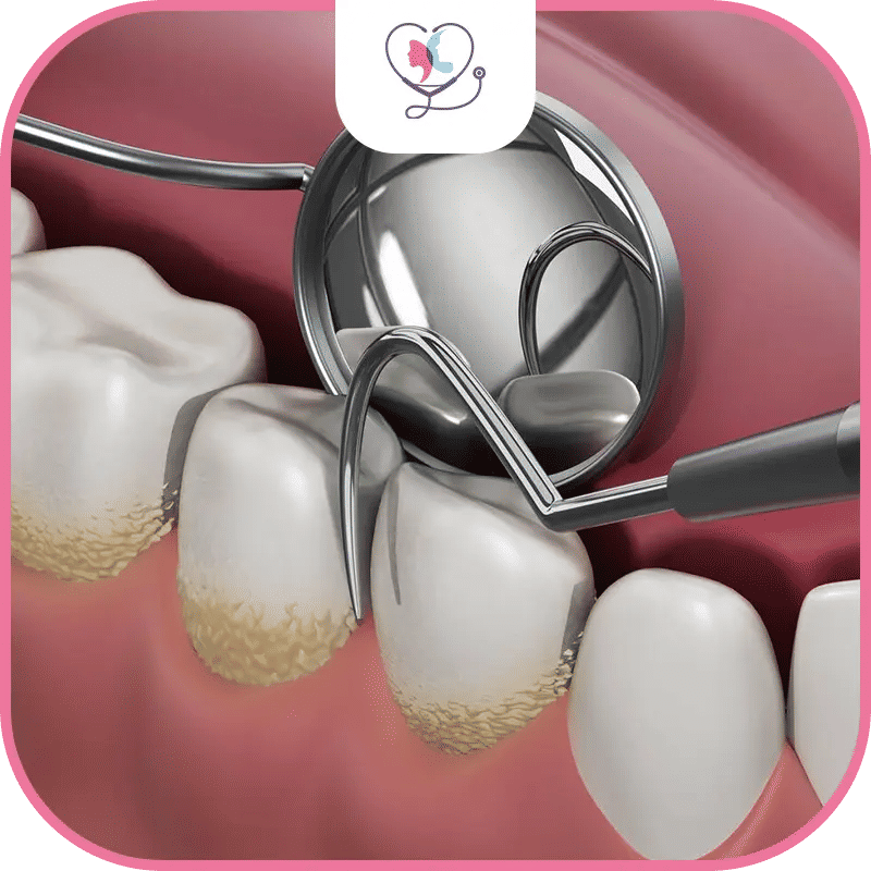 ما هي أسعار تنظيف الأسنان في تركيا؟