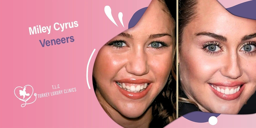 Faccette Dentali Miley Cyrus: Trasformazione 2025