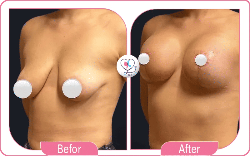 تجربتي مع سيليكون الثدي نتائج بالصور