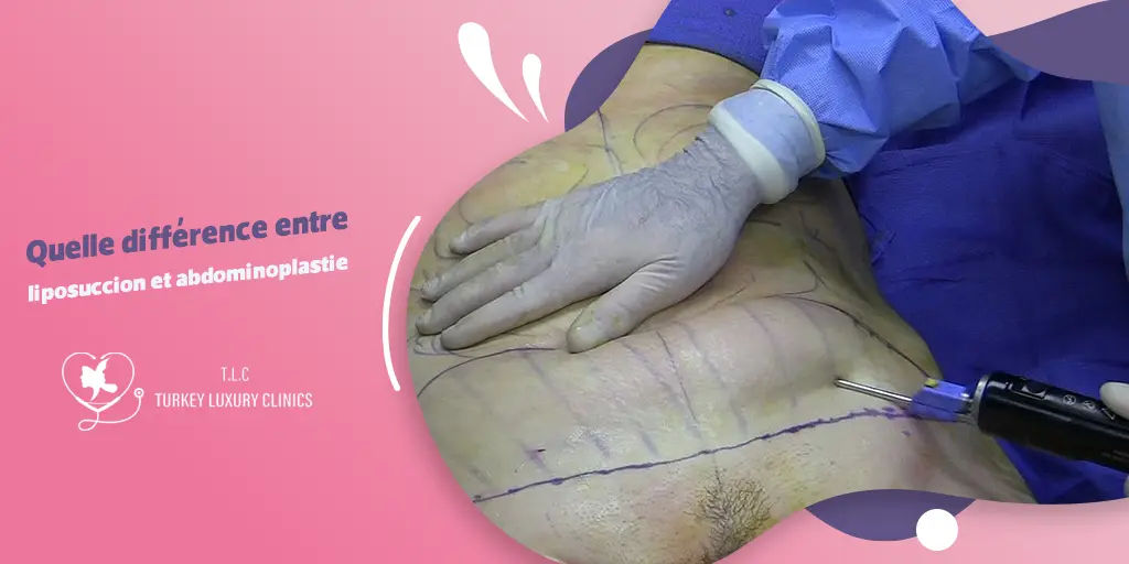 Quelle différence entre liposuccion et abdominoplastie ?