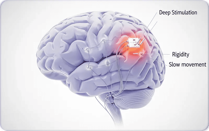 What is Deep Brain Stimulation for Parkinson's?