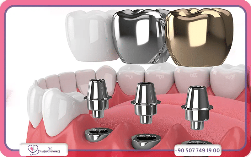 ما هي مدة زراعة الأسنان بعد الخلع؟