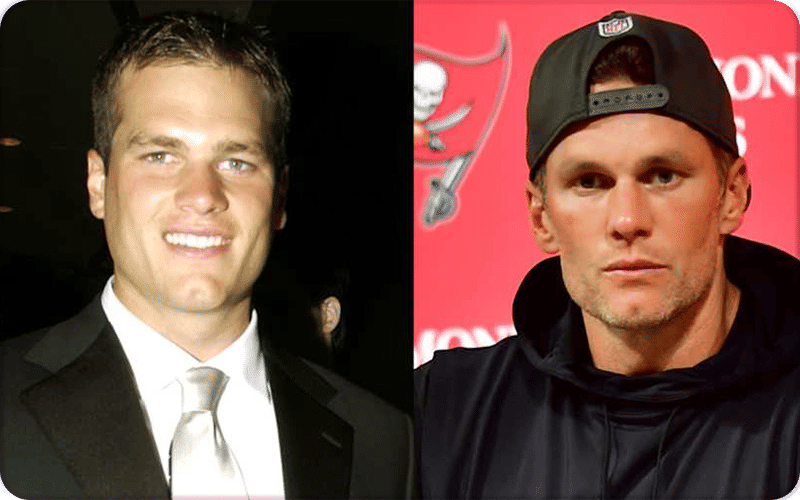 Tom Brady Plastic Surgery Pictures
