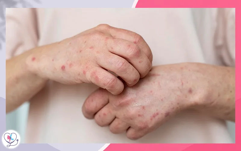 أعراض مرض الكسب ضد المضيف بعد الزراعة