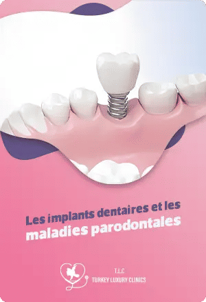 Les implants dentaires et les maladies parodontales