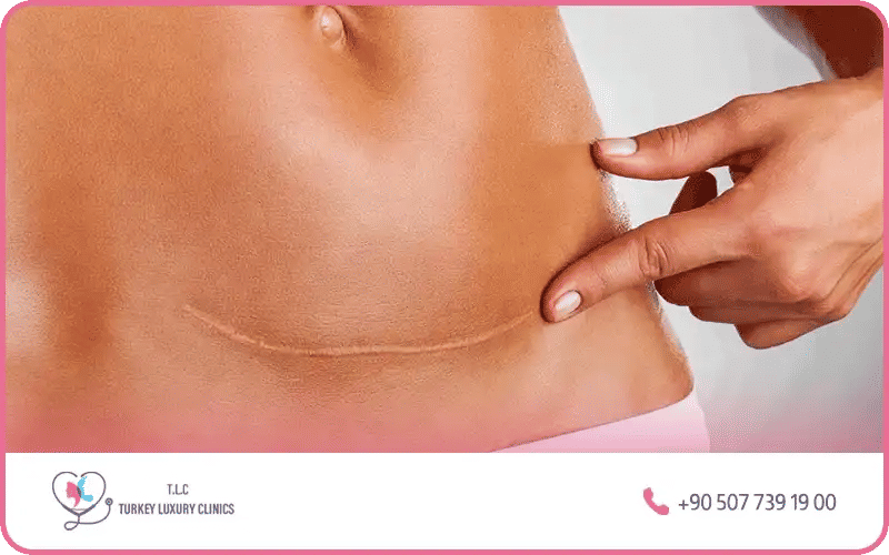 شكل البطن بعد الولادة القيصرية بالصور