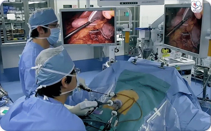 Qu’est-ce que la Sleeve Gastroplastie Endoscopique ?