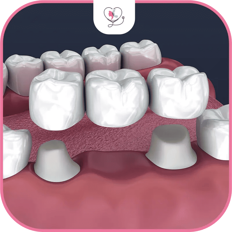 bridge dentaire - bridge dentaire 1 dent - bridge dentaire 2 dents