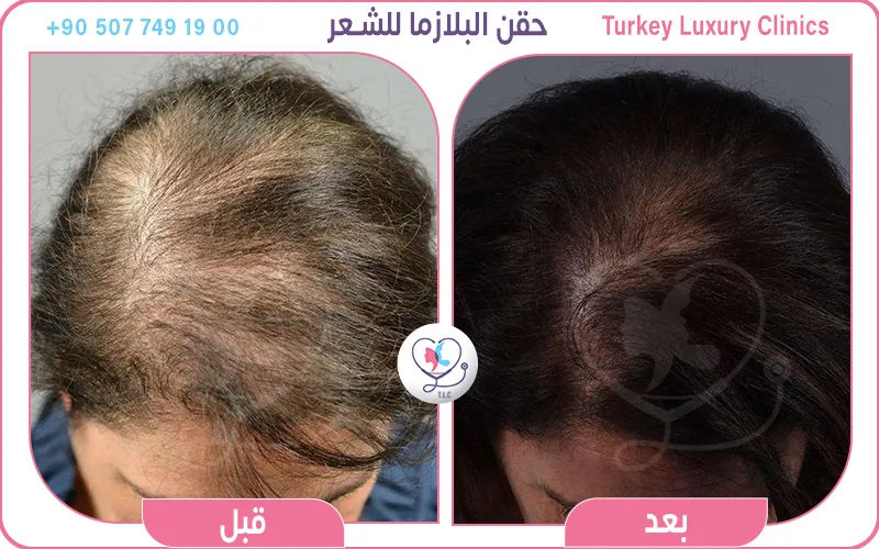 حقن البلازما للشعر قبل وبعد