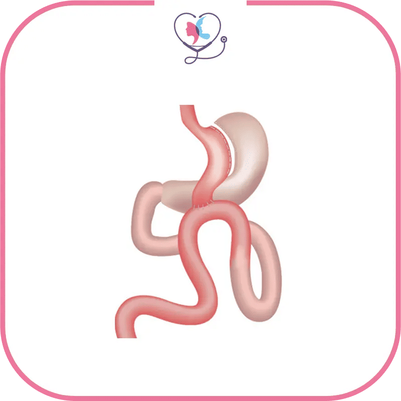 تكلفة عملية تحويل المسار المصغر في تركيا