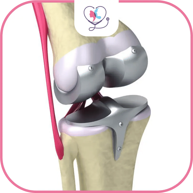 prothese du genou turquie