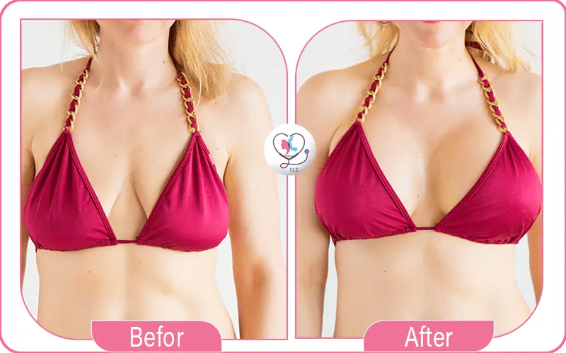 تصغير عمليات شد الثدي قبل وبعد