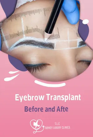 Augenbrauen-Transplantation Vorher-Nachher: Echte Ergebnisse & Fotos 2026featured image