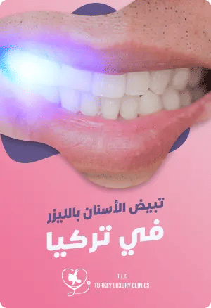 تبييض الأسنان بالليزر في تركياfeatured image
