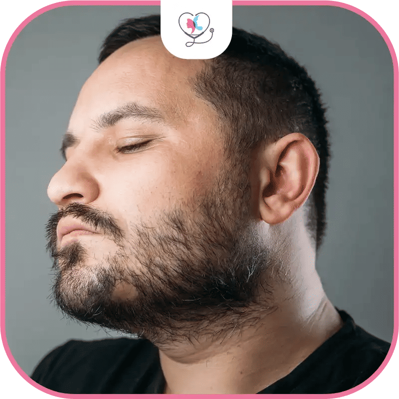 candidat idéal greffe de barbe