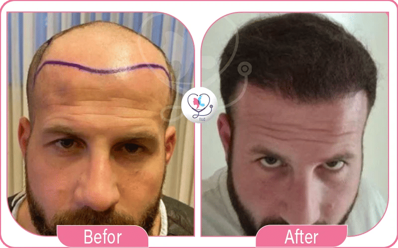 خامساً: زراعة اللحية للرجال